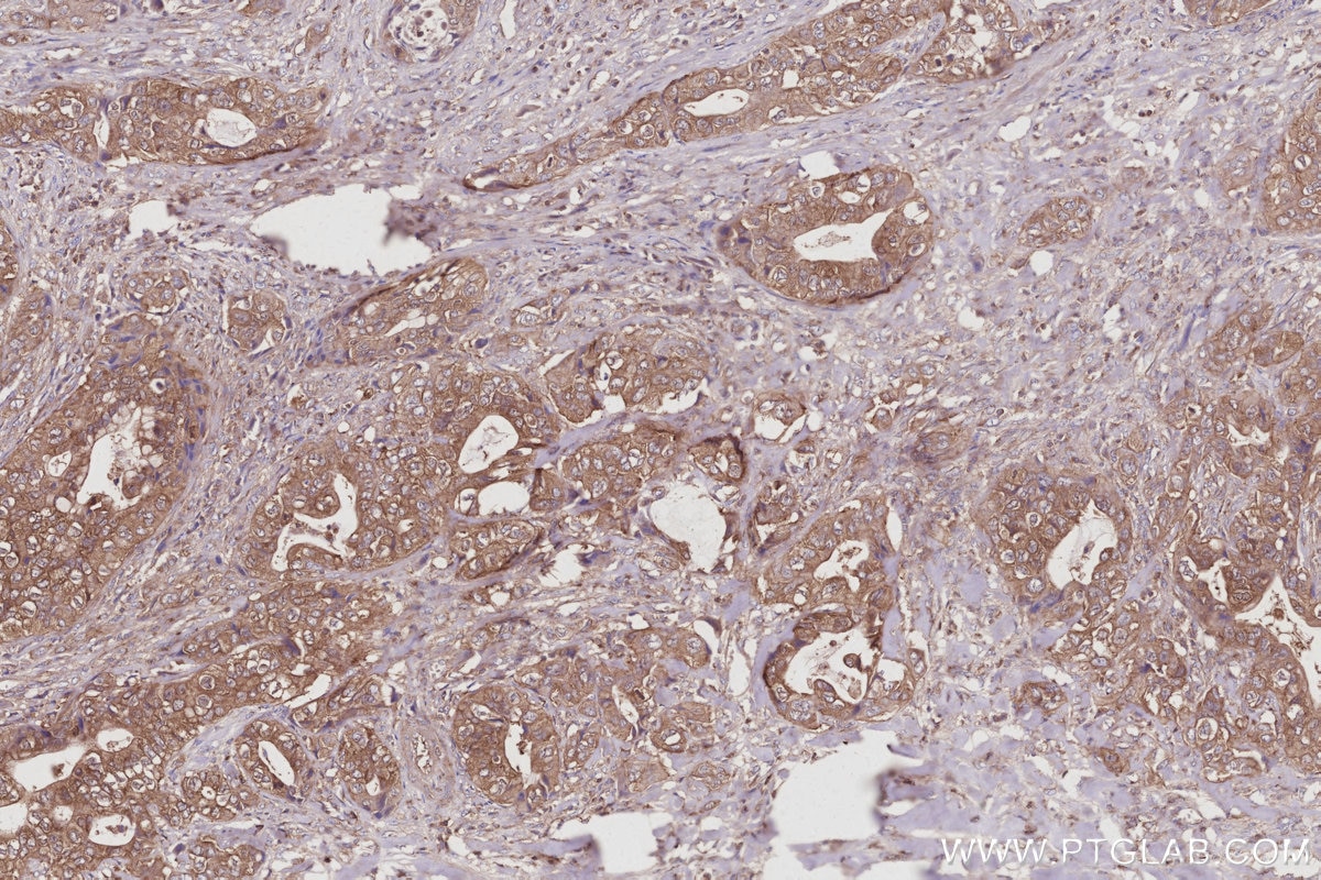 Immunohistochemistry (IHC) staining of human pancreas cancer tissue using MST4 Polyclonal antibody (10847-1-AP)