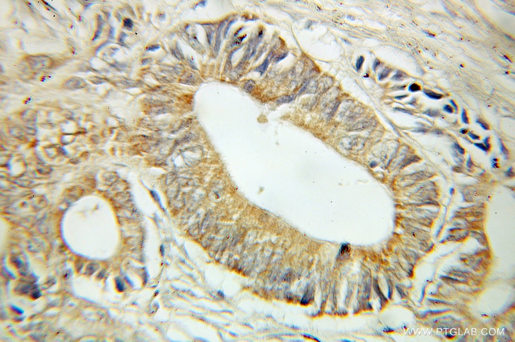 Immunohistochemistry (IHC) staining of human colon cancer tissue using MST4 Polyclonal antibody (10847-1-AP)