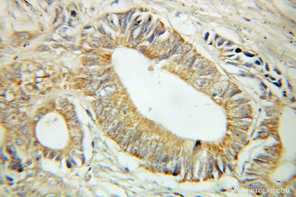 Immunohistochemistry (IHC) staining of human colon cancer tissue using MST4 Polyclonal antibody (10847-1-AP)