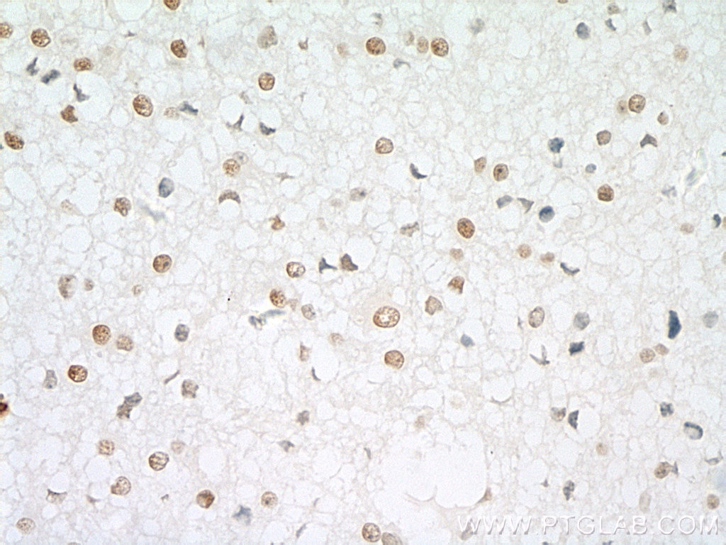 Immunohistochemistry (IHC) staining of human gliomas tissue using RPA2 Polyclonal antibody (10412-1-Ap)