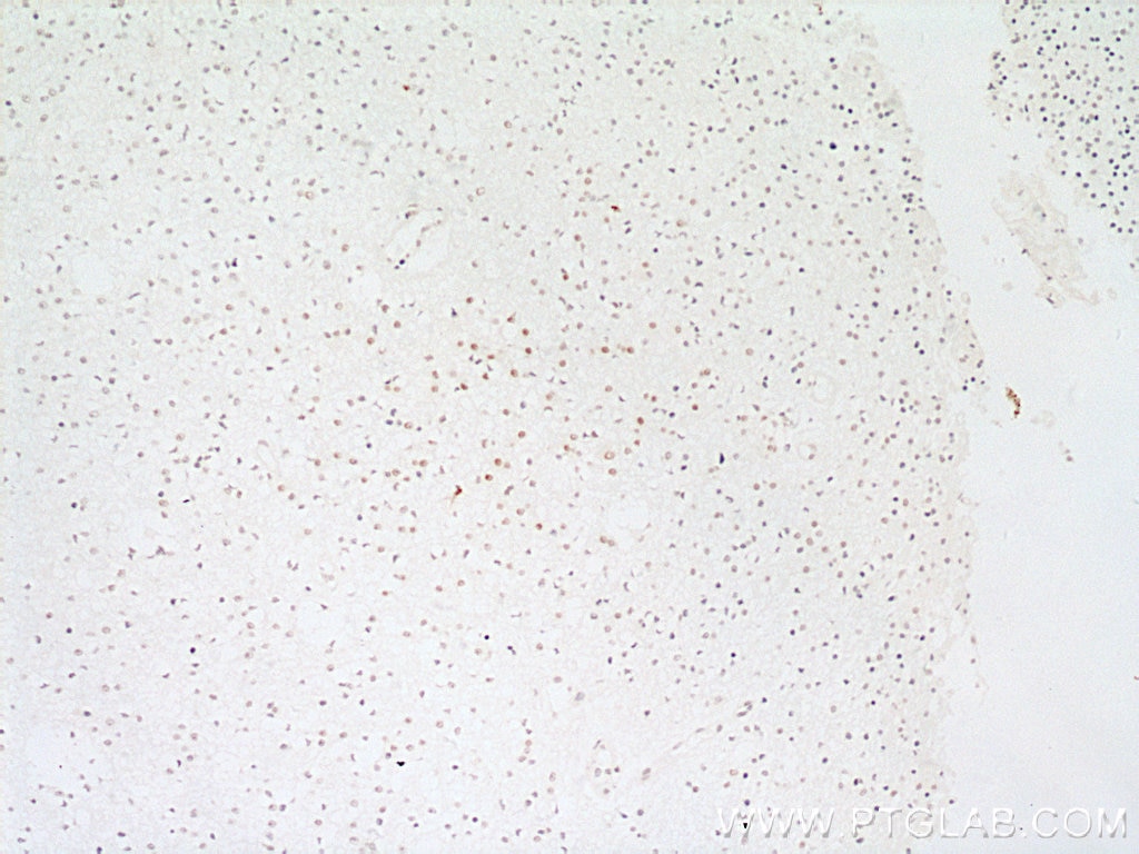 IHC staining of human gliomas using 10412-1-Ap