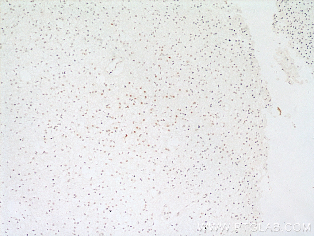 Immunohistochemistry (IHC) staining of human gliomas tissue using RPA2 Polyclonal antibody (10412-1-Ap)