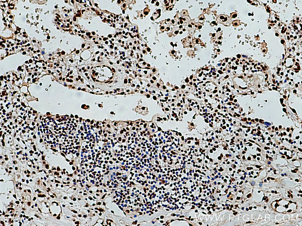 Immunohistochemistry (IHC) staining of human lung cancer tissue using RPA3 Polyclonal antibody (10692-1-AP)
