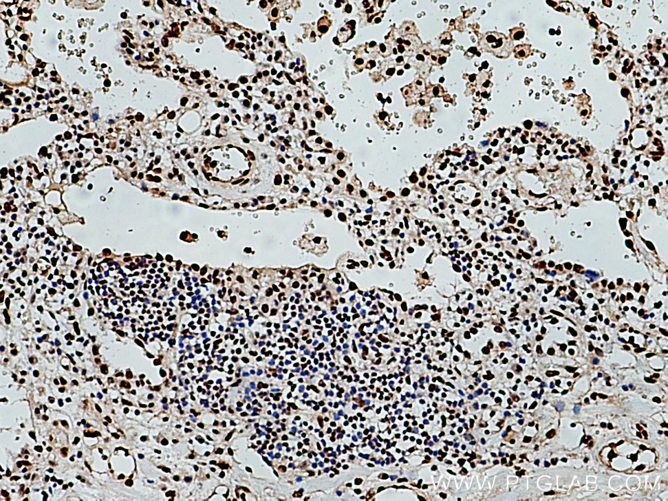 IHC staining of human lung cancer using 10692-1-AP