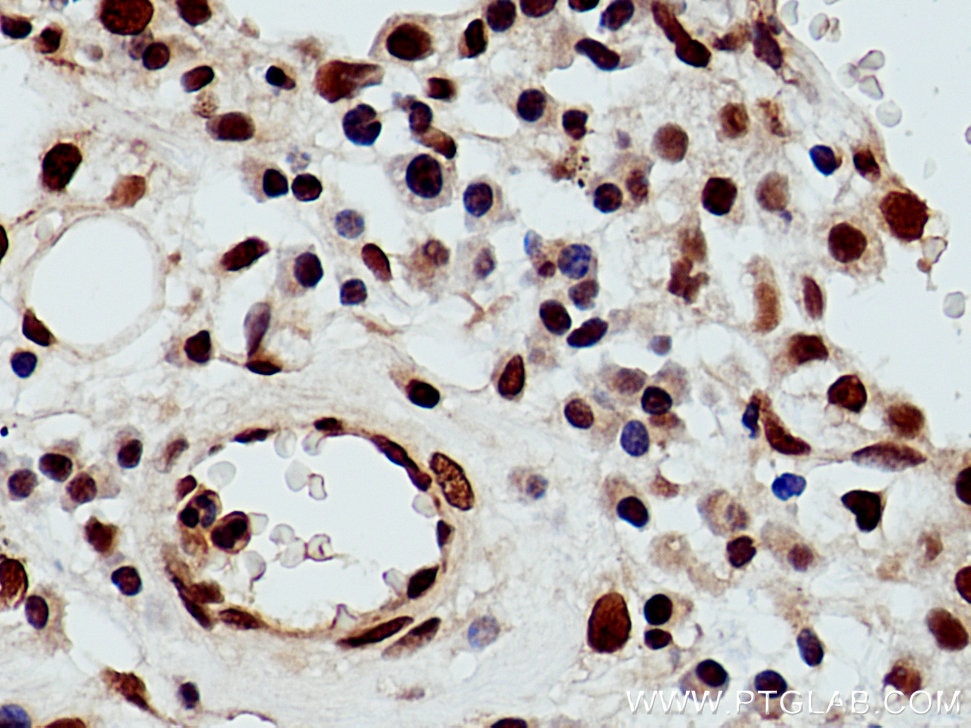 Immunohistochemistry (IHC) staining of human lung cancer tissue using RPA3 Polyclonal antibody (10692-1-AP)