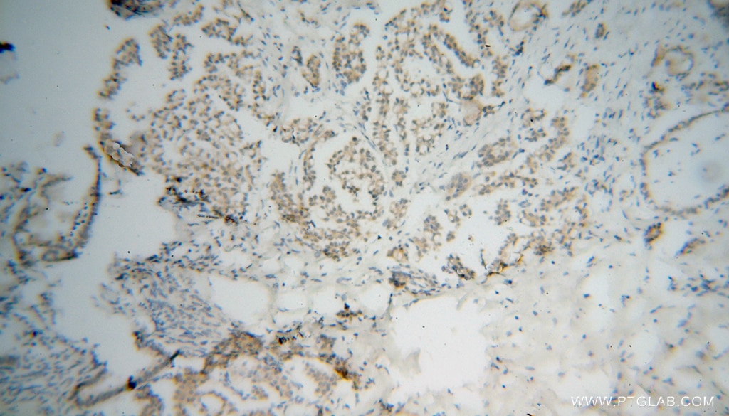 Immunohistochemistry (IHC) staining of human ovary tumor tissue using RPAIN Polyclonal antibody (15220-1-AP)