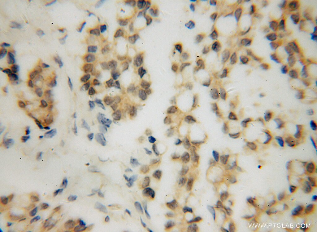 Immunohistochemistry (IHC) staining of human ovary tumor tissue using RPAIN Polyclonal antibody (15220-1-AP)