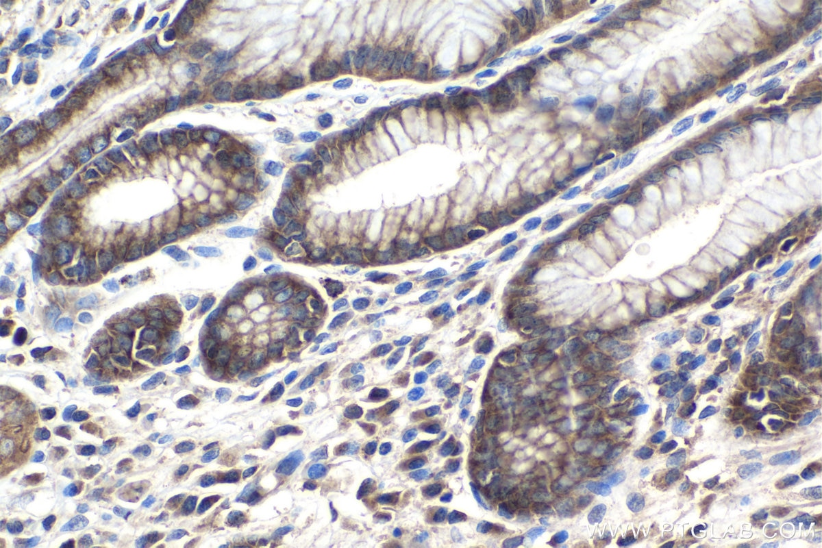 Immunohistochemistry (IHC) staining of human stomach cancer tissue using RPAP3 Polyclonal antibody (23741-1-AP)