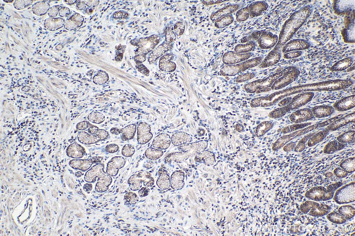 Immunohistochemistry (IHC) staining of human stomach cancer tissue using RPAP3 Polyclonal antibody (23741-1-AP)
