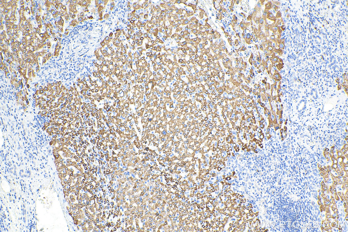 Immunohistochemistry (IHC) staining of human liver cancer tissue using RPL11 Polyclonal antibody (16277-1-AP)