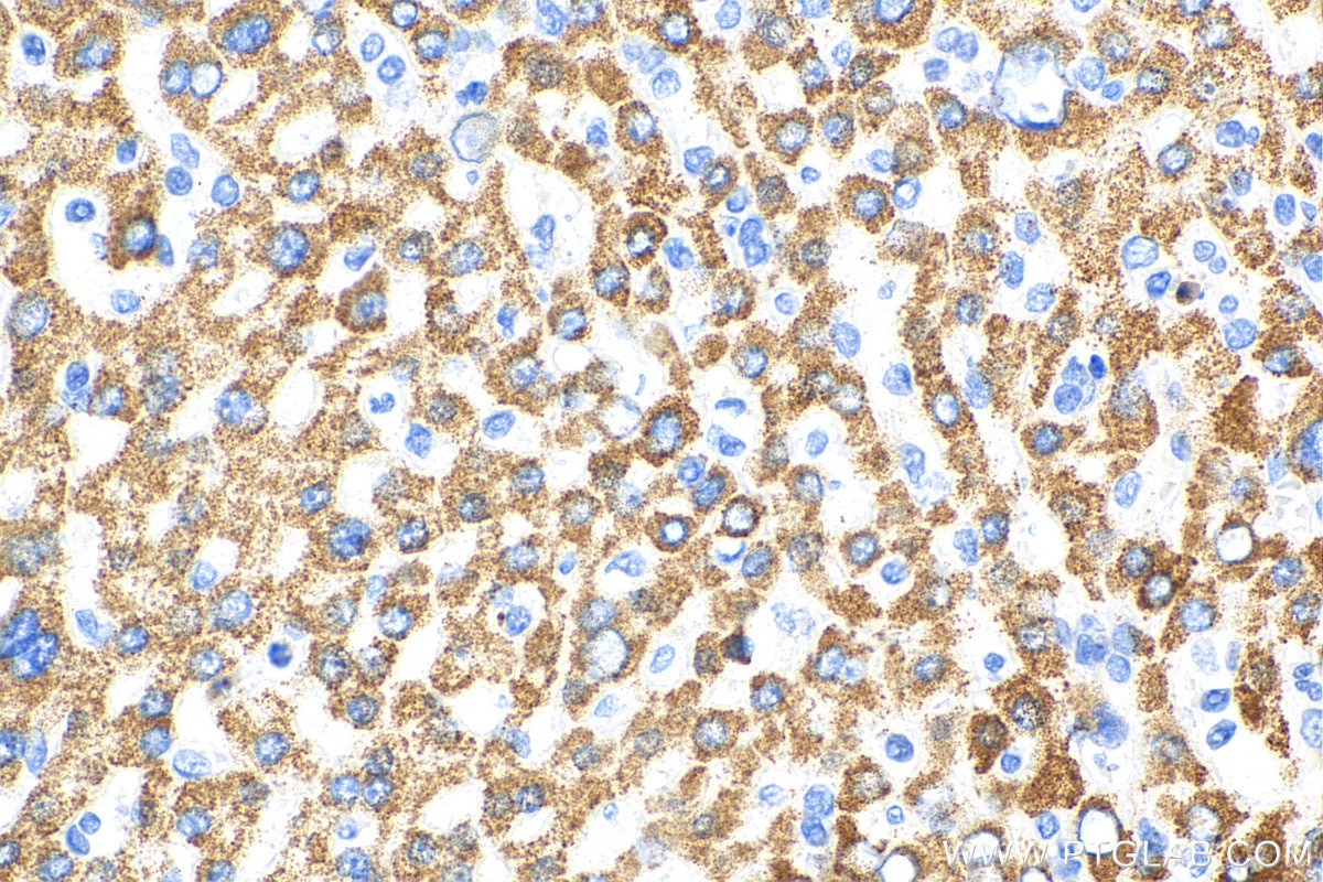 Immunohistochemistry (IHC) staining of human liver cancer tissue using RPL11 Polyclonal antibody (16277-1-AP)