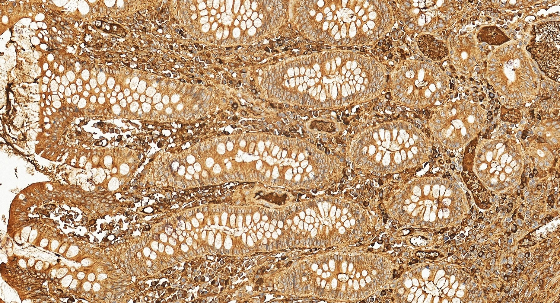 IHC staining of human colon cancer using 11271-1-AP Immunohistochemistry (IHC) staining of human colon cancer tissue using RPL13 Polyclonal antibody (11271-1-AP)