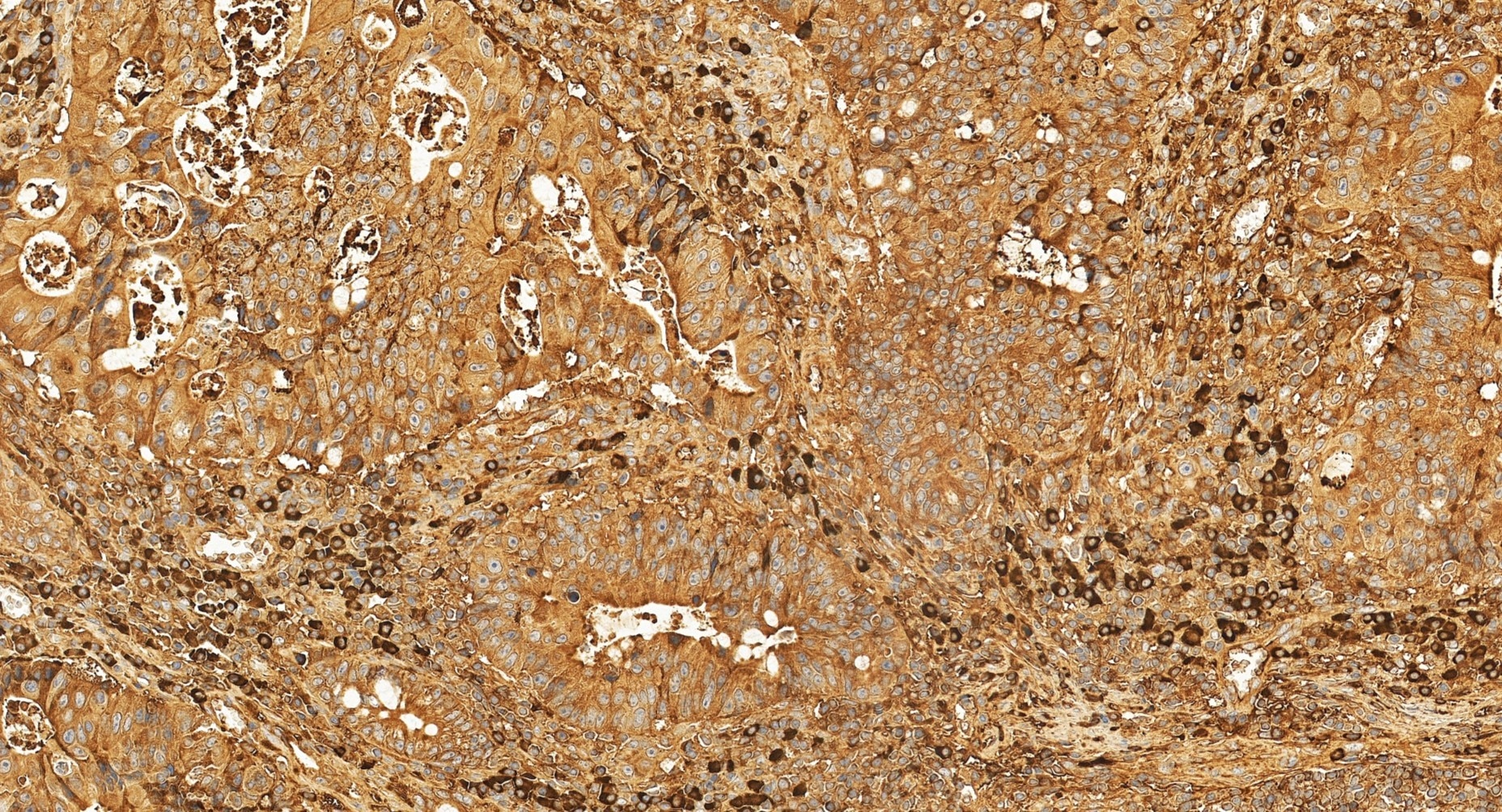 IHC staining of human colon cancer using 11271-1-AP Immunohistochemistry (IHC) staining of human colon cancer tissue using RPL13 Polyclonal antibody (11271-1-AP)