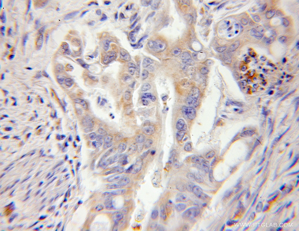 Immunohistochemistry (IHC) staining of human colon cancer tissue using RPL13 Polyclonal antibody (11271-1-AP)