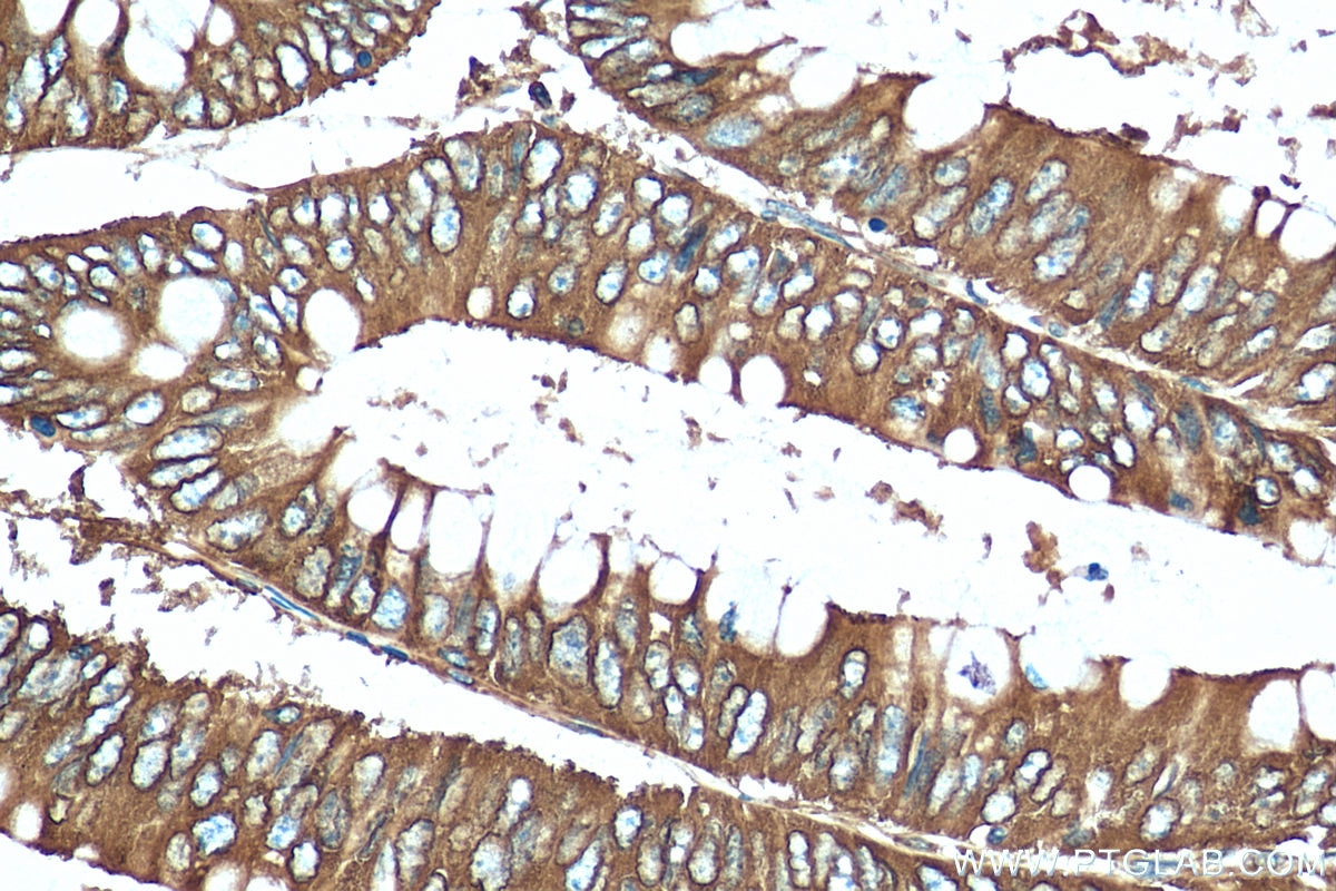 Immunohistochemistry (IHC) staining of human colon cancer tissue using RPL14 Polyclonal antibody (14991-1-AP)