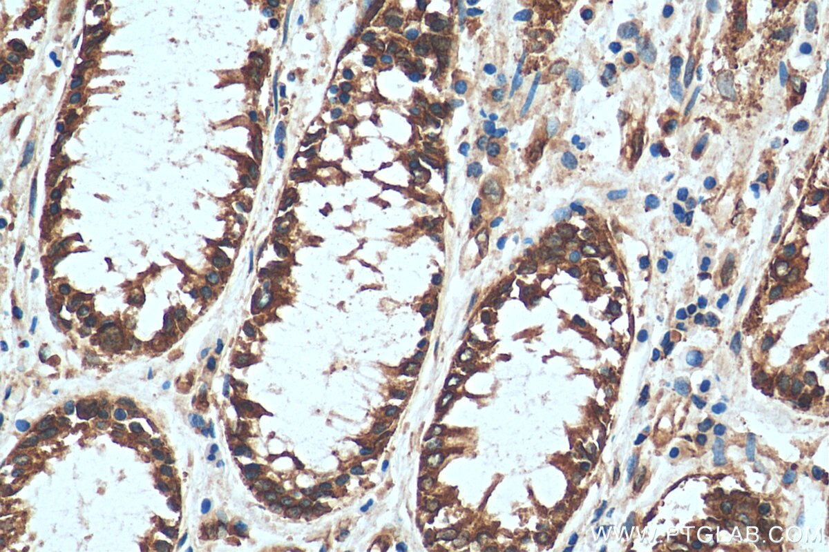 Immunohistochemistry (IHC) staining of human colon cancer tissue using RPL14 Polyclonal antibody (14991-1-AP)