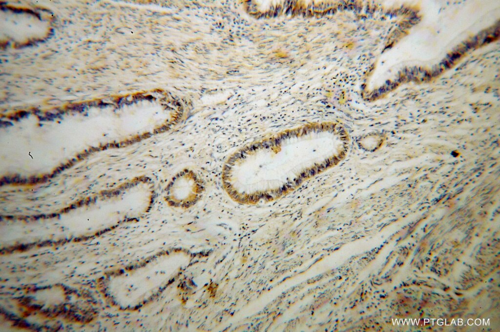 Immunohistochemistry (IHC) staining of human colon cancer tissue using RPL14 Polyclonal antibody (14991-1-AP)