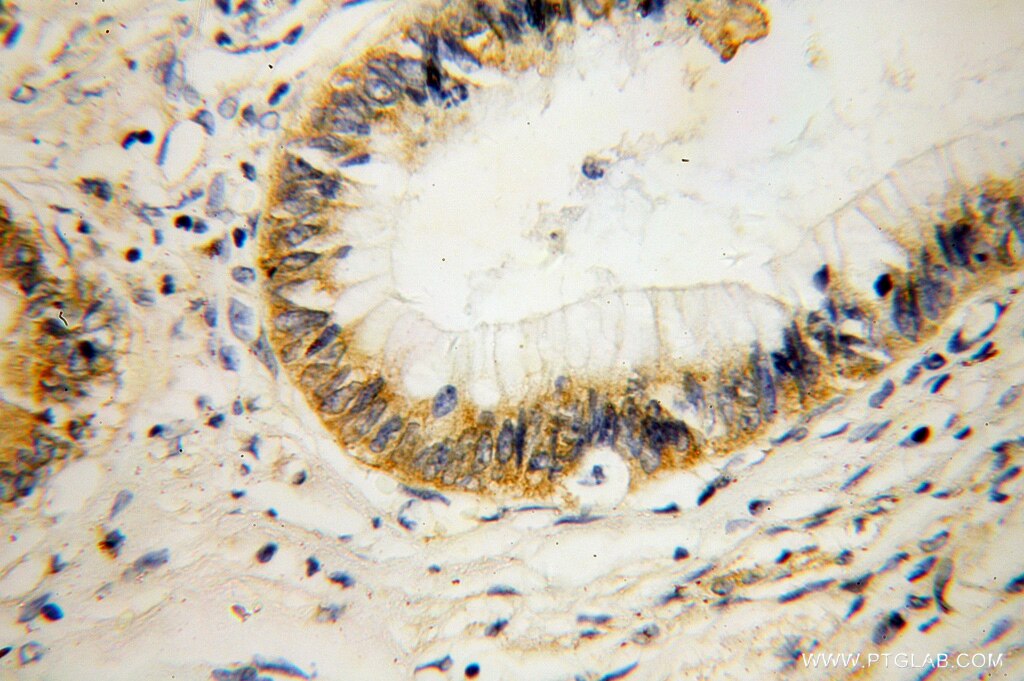 Immunohistochemistry (IHC) staining of human colon cancer tissue using RPL14 Polyclonal antibody (14991-1-AP)