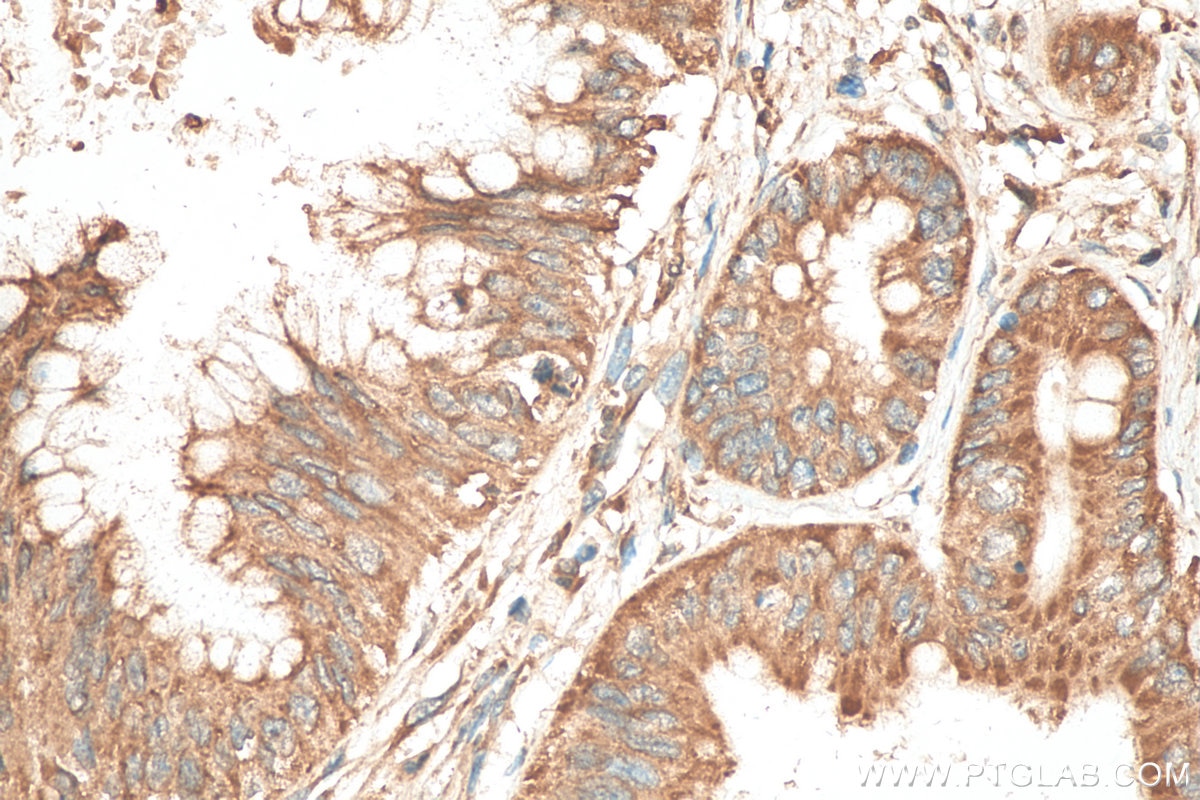 Immunohistochemistry (IHC) staining of human pancreas cancer tissue using RPL17 Polyclonal antibody (14121-1-AP)