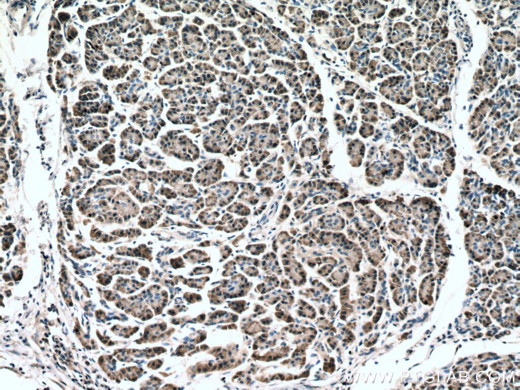 Immunohistochemistry (IHC) staining of human pancreas cancer tissue using RPL17 Monoclonal antibody (67223-1-Ig)