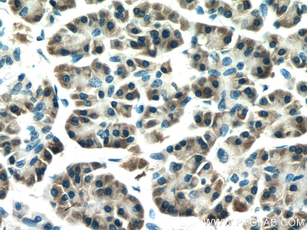 Immunohistochemistry (IHC) staining of human pancreas cancer tissue using RPL17 Monoclonal antibody (67223-1-Ig)