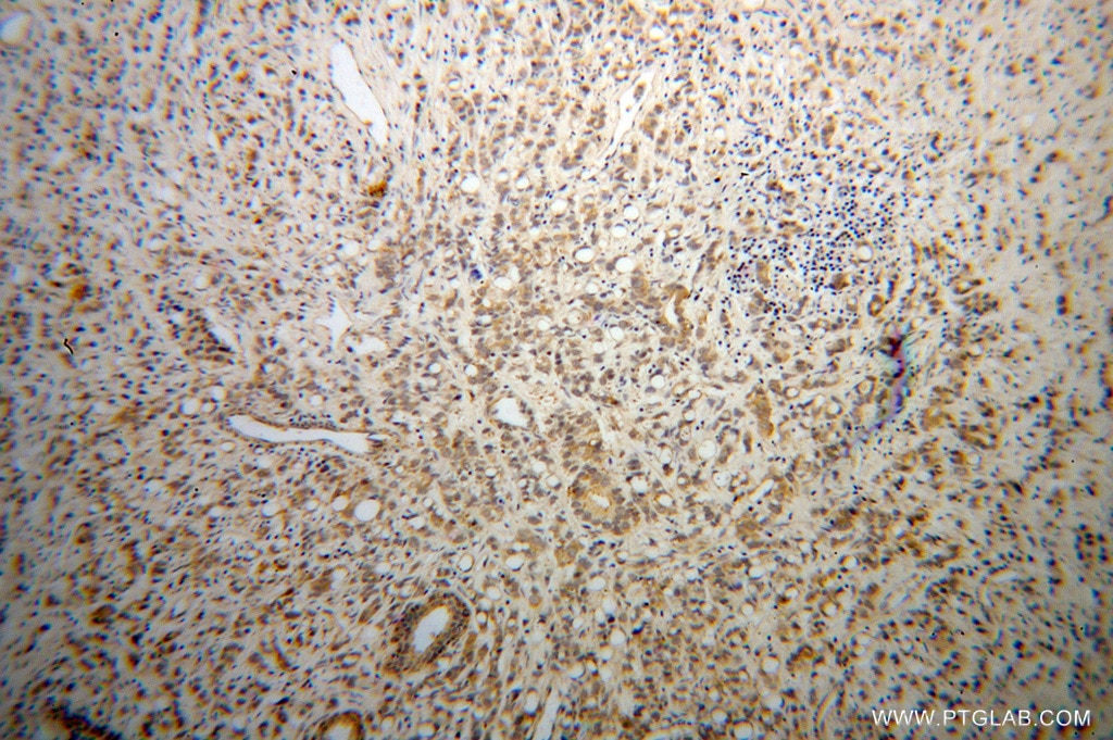 Immunohistochemistry (IHC) staining of human prostate cancer tissue using RPL18A Polyclonal antibody (14653-1-AP)