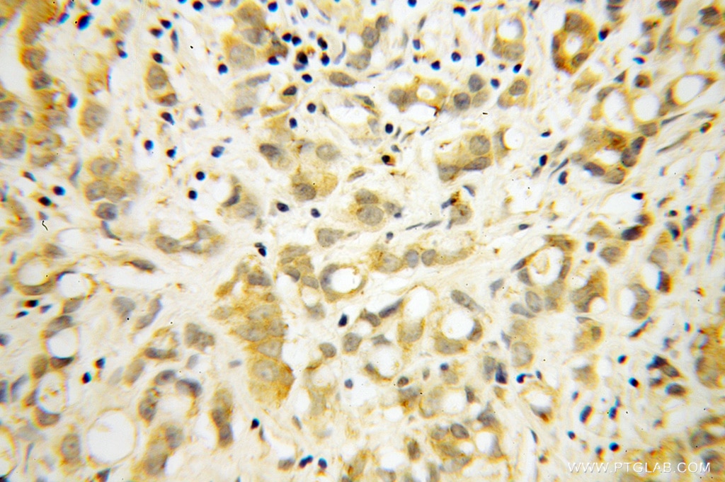 Immunohistochemistry (IHC) staining of human prostate cancer tissue using RPL18A Polyclonal antibody (14653-1-AP)