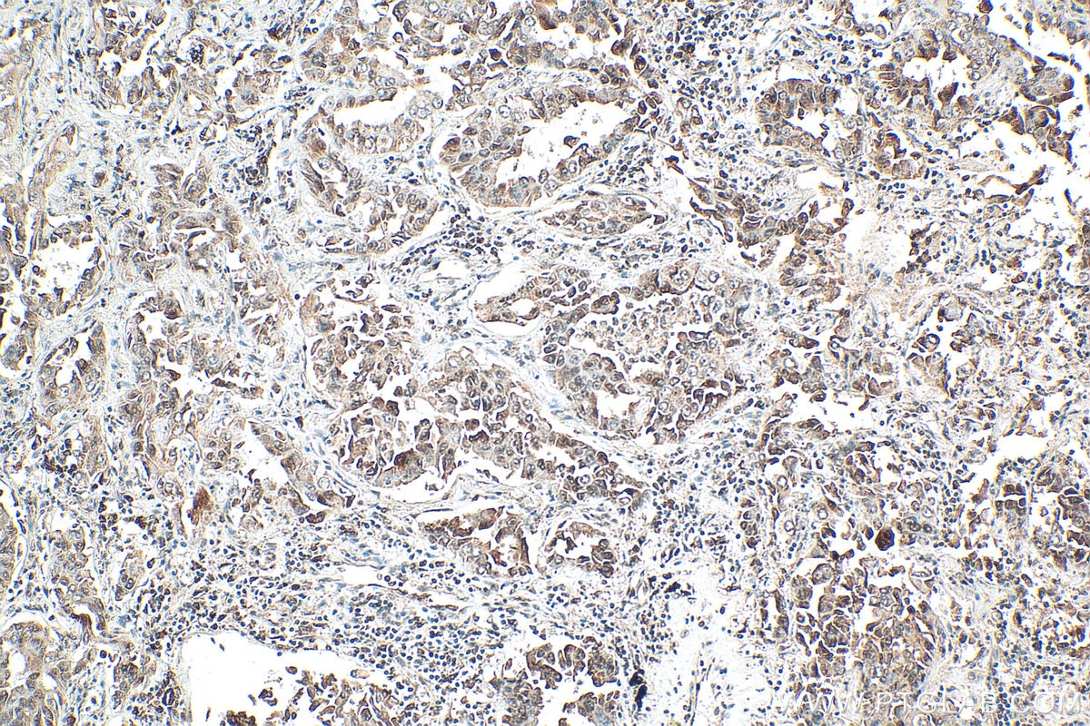 Immunohistochemistry (IHC) staining of human lung cancer tissue using RPL26L1 Polyclonal antibody (16487-1-AP)