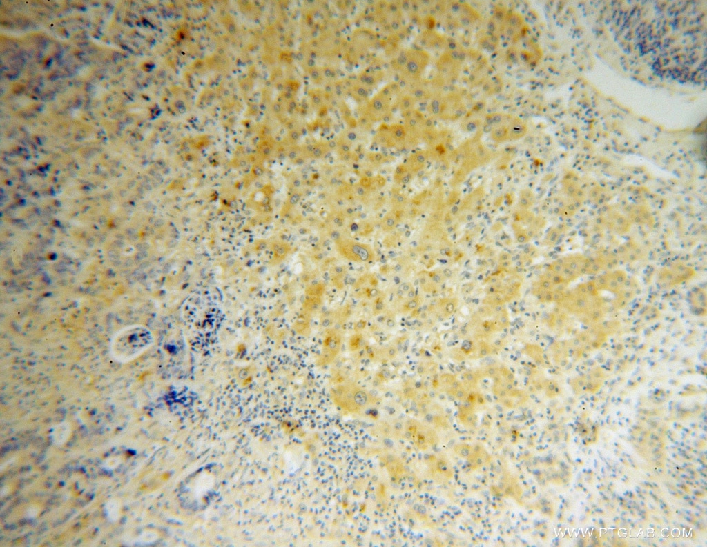 Immunohistochemistry (IHC) staining of human liver cancer tissue using RPL27 Polyclonal antibody (14980-1-AP)