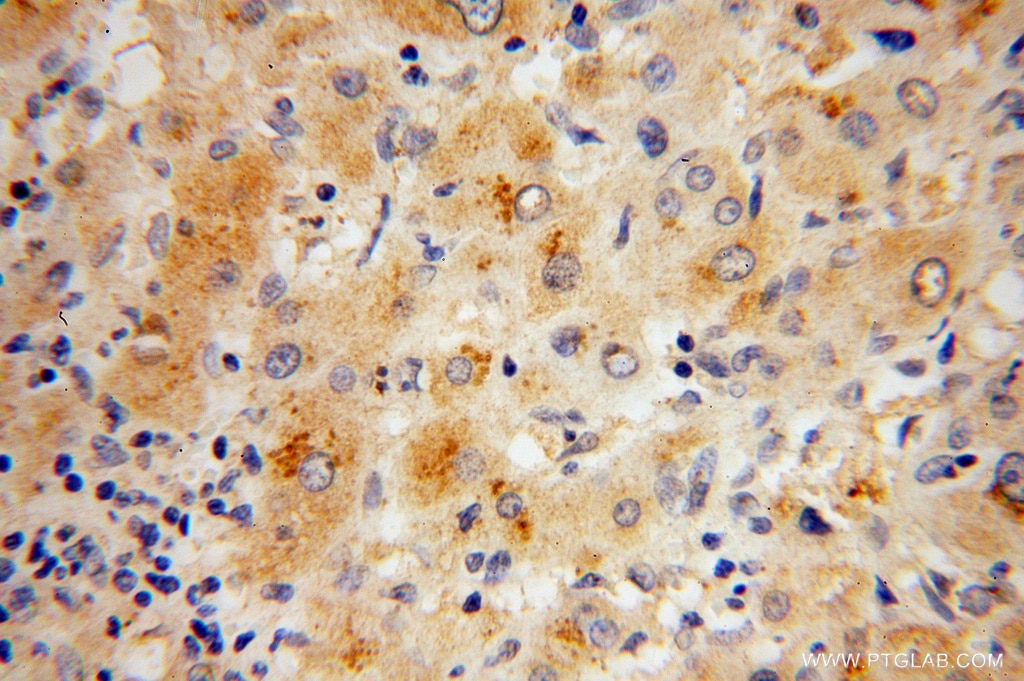 Immunohistochemistry (IHC) staining of human liver cancer tissue using RPL27 Polyclonal antibody (14980-1-AP)