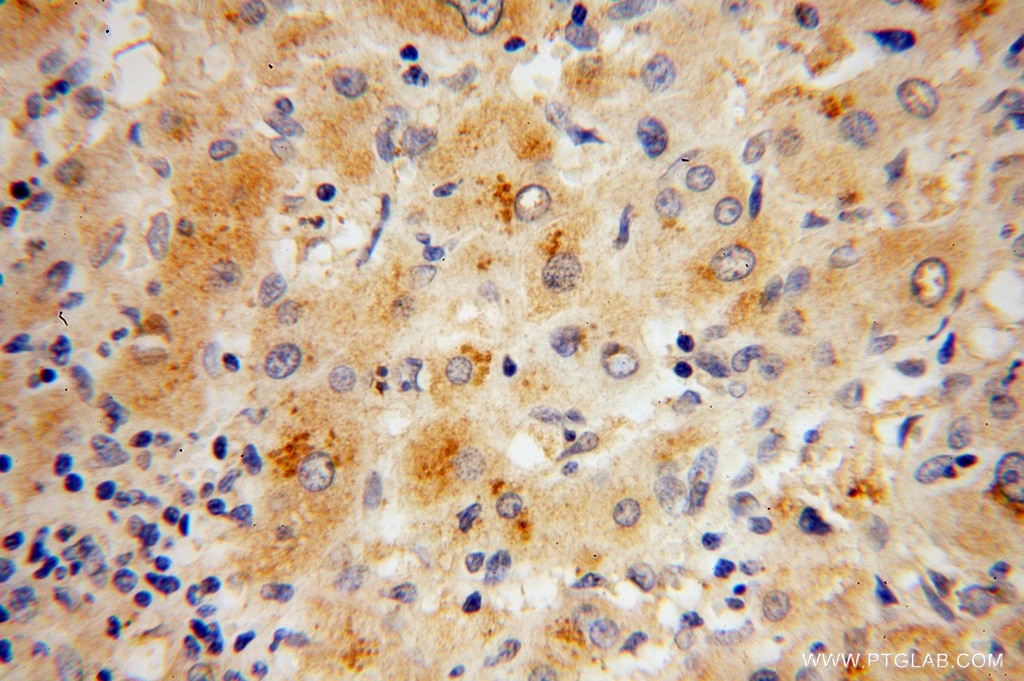 IHC staining of human liver cancer using 14980-1-AP