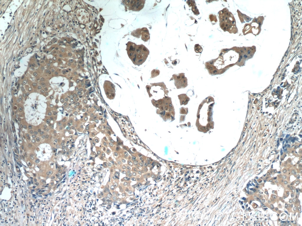 IHC staining of human breast cancer using 15799-1-AP