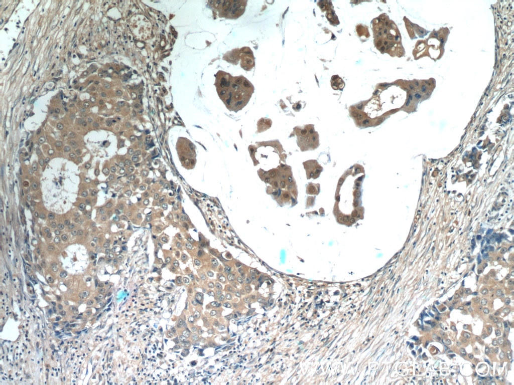 Immunohistochemistry (IHC) staining of human breast cancer tissue using RPL29 Polyclonal antibody (15799-1-AP)