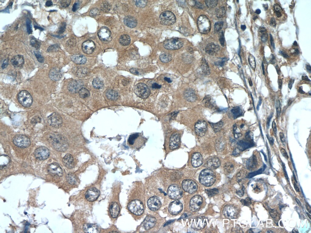 Immunohistochemistry (IHC) staining of human breast cancer tissue using RPL29 Polyclonal antibody (15799-1-AP)