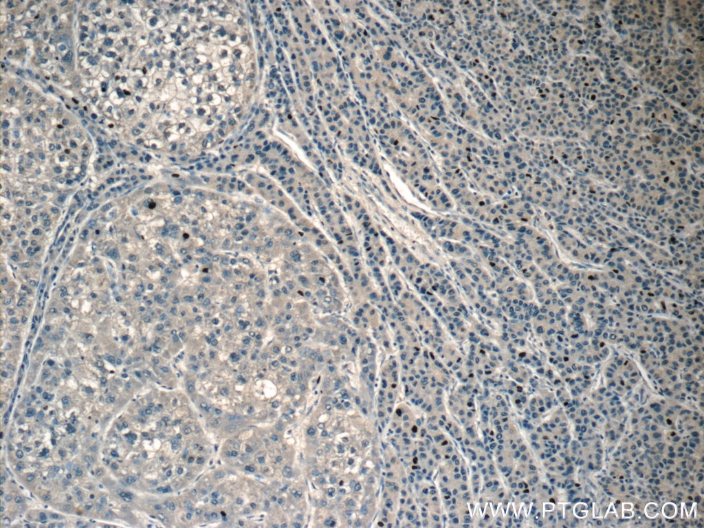 Immunohistochemistry (IHC) staining of human liver cancer tissue using RPL29 Polyclonal antibody (15799-1-AP)