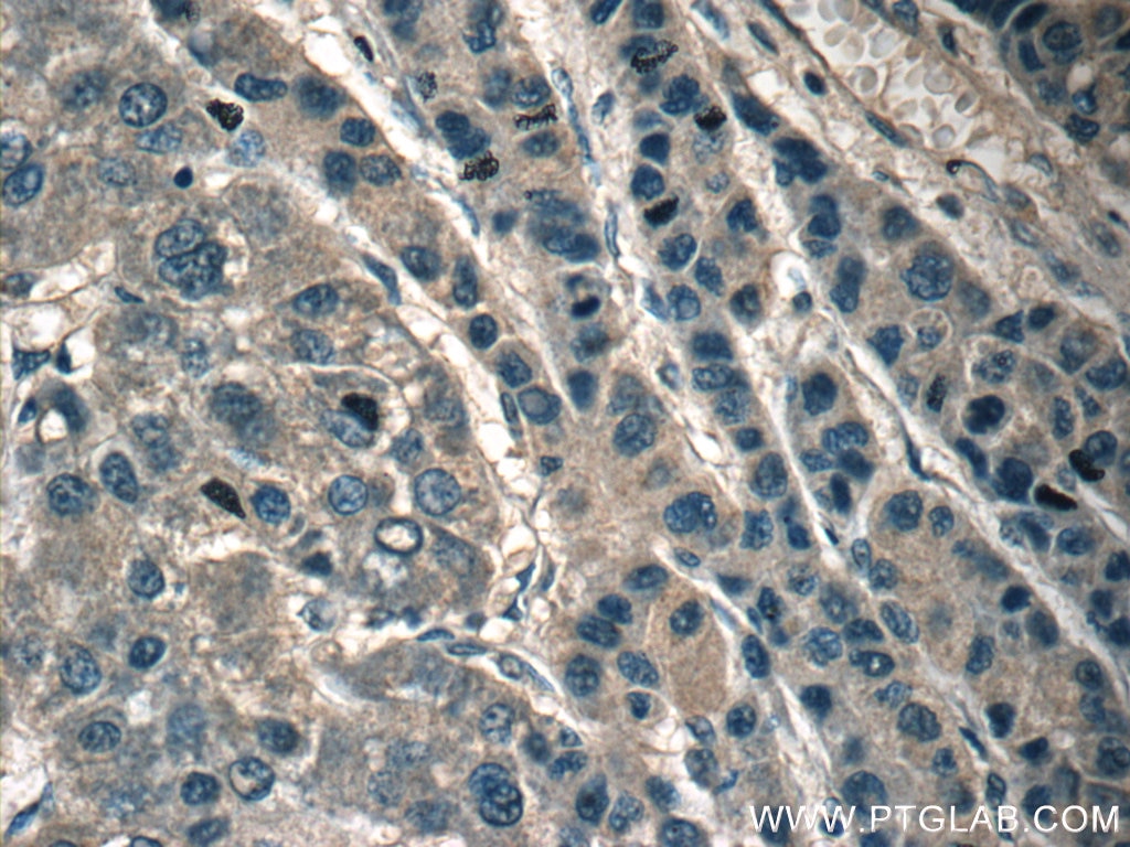 Immunohistochemistry (IHC) staining of human liver cancer tissue using RPL29 Polyclonal antibody (15799-1-AP)