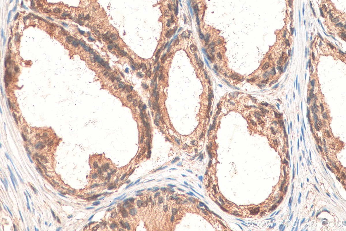 Immunohistochemistry (IHC) staining of human prostate cancer tissue using RPL3 Polyclonal antibody (11005-1-AP)