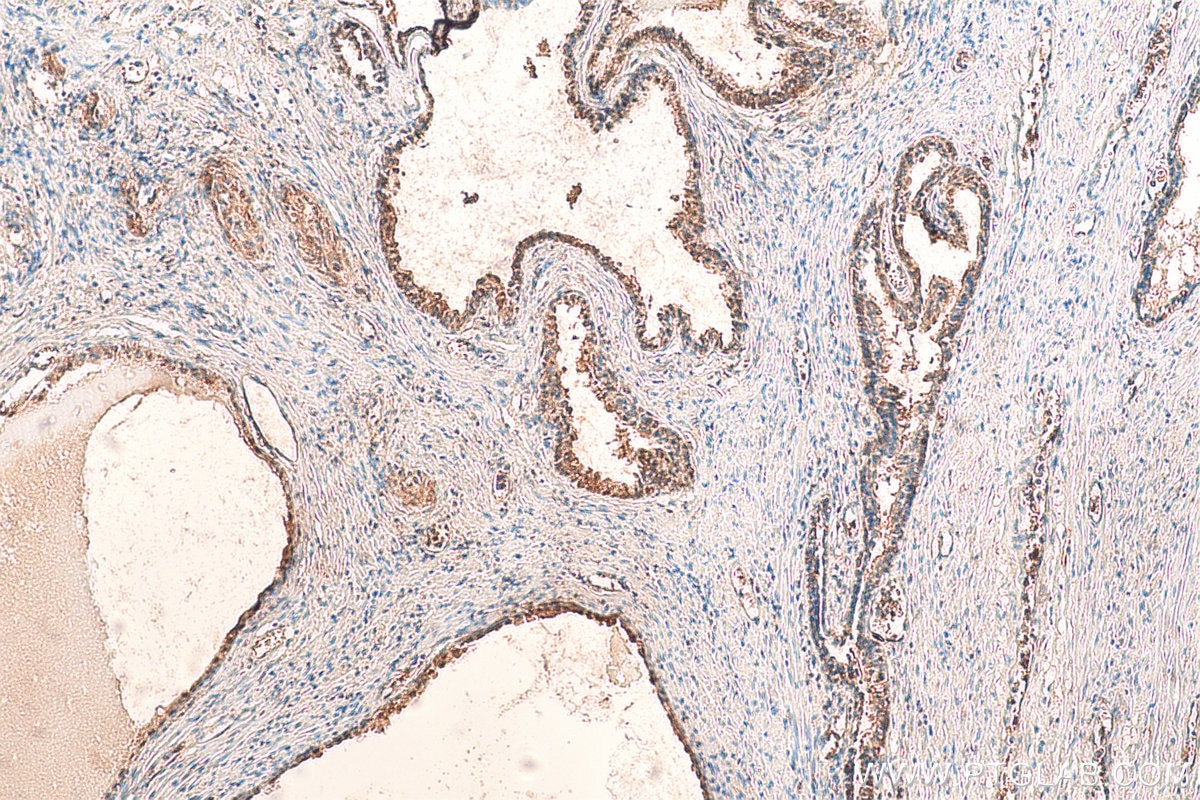 Immunohistochemistry (IHC) staining of human prostate cancer tissue using RPL3 Polyclonal antibody (11005-1-AP)