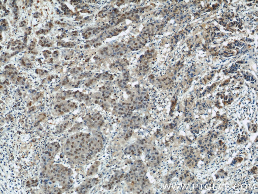 IHC staining of human prostate cancer using 11005-1-AP
