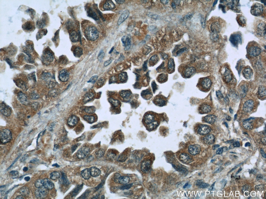 Immunohistochemistry (IHC) staining of human lung cancer tissue using RPL3 Monoclonal antibody (66130-1-Ig)