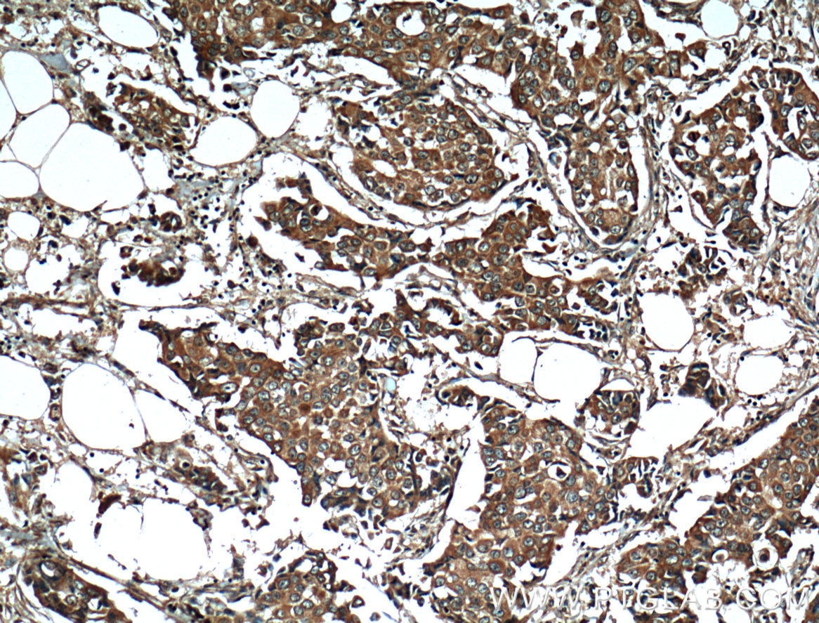 Immunohistochemistry (IHC) staining of human breast cancer tissue using RPL3 Monoclonal antibody (66130-1-Ig)