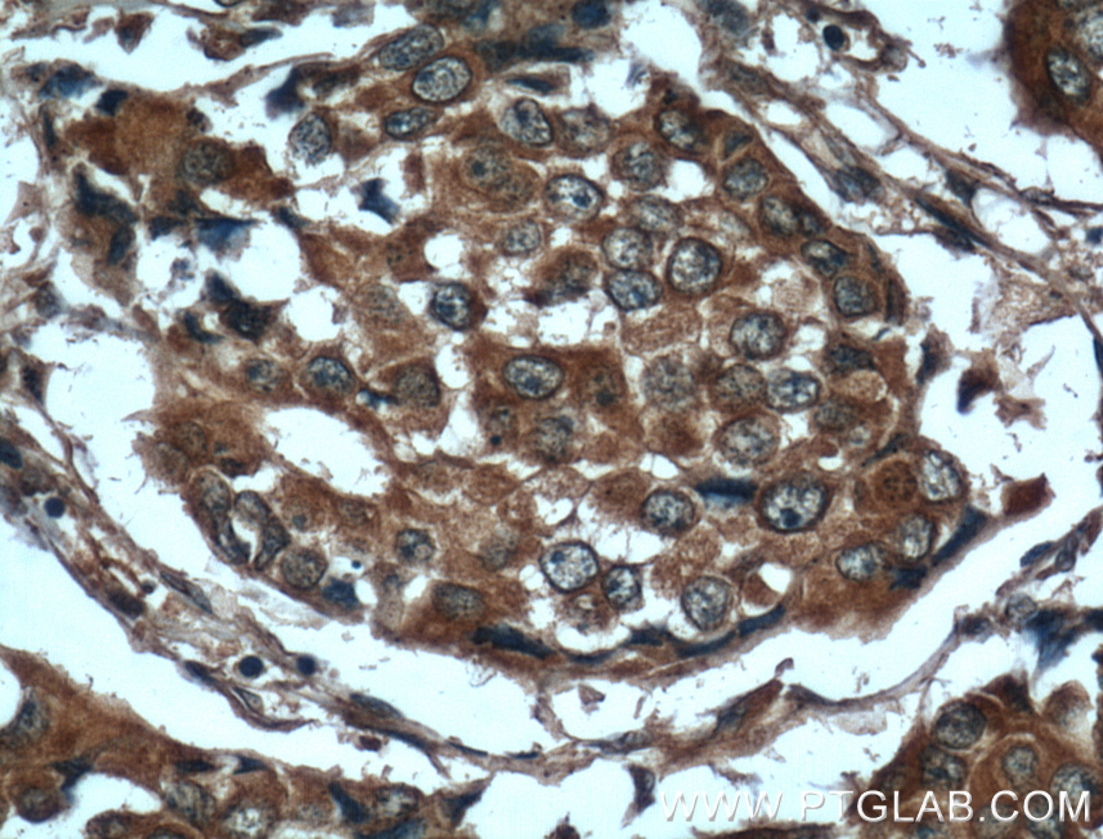 IHC staining of human breast cancer using 66130-1-Ig