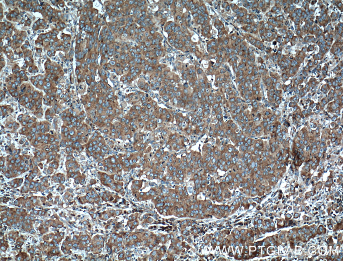 Immunohistochemistry (IHC) staining of human prostate cancer tissue using RPL3 Monoclonal antibody (66130-1-Ig)