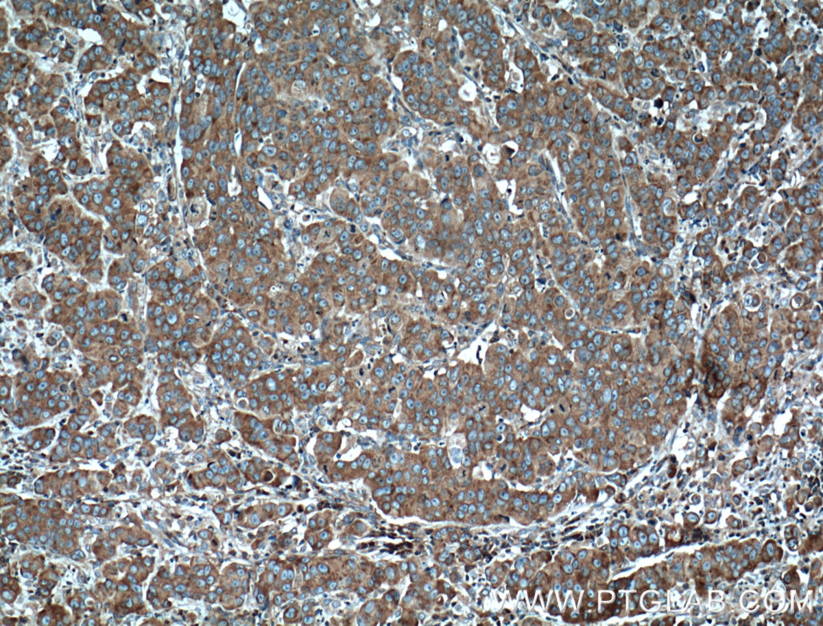 Immunohistochemistry (IHC) staining of human prostate cancer tissue using RPL3 Monoclonal antibody (66130-1-Ig)