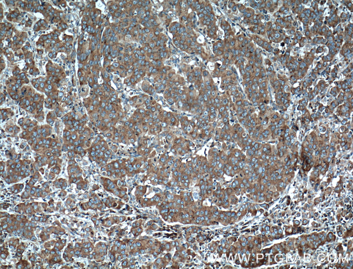 IHC staining of human prostate cancer using 66130-1-Ig