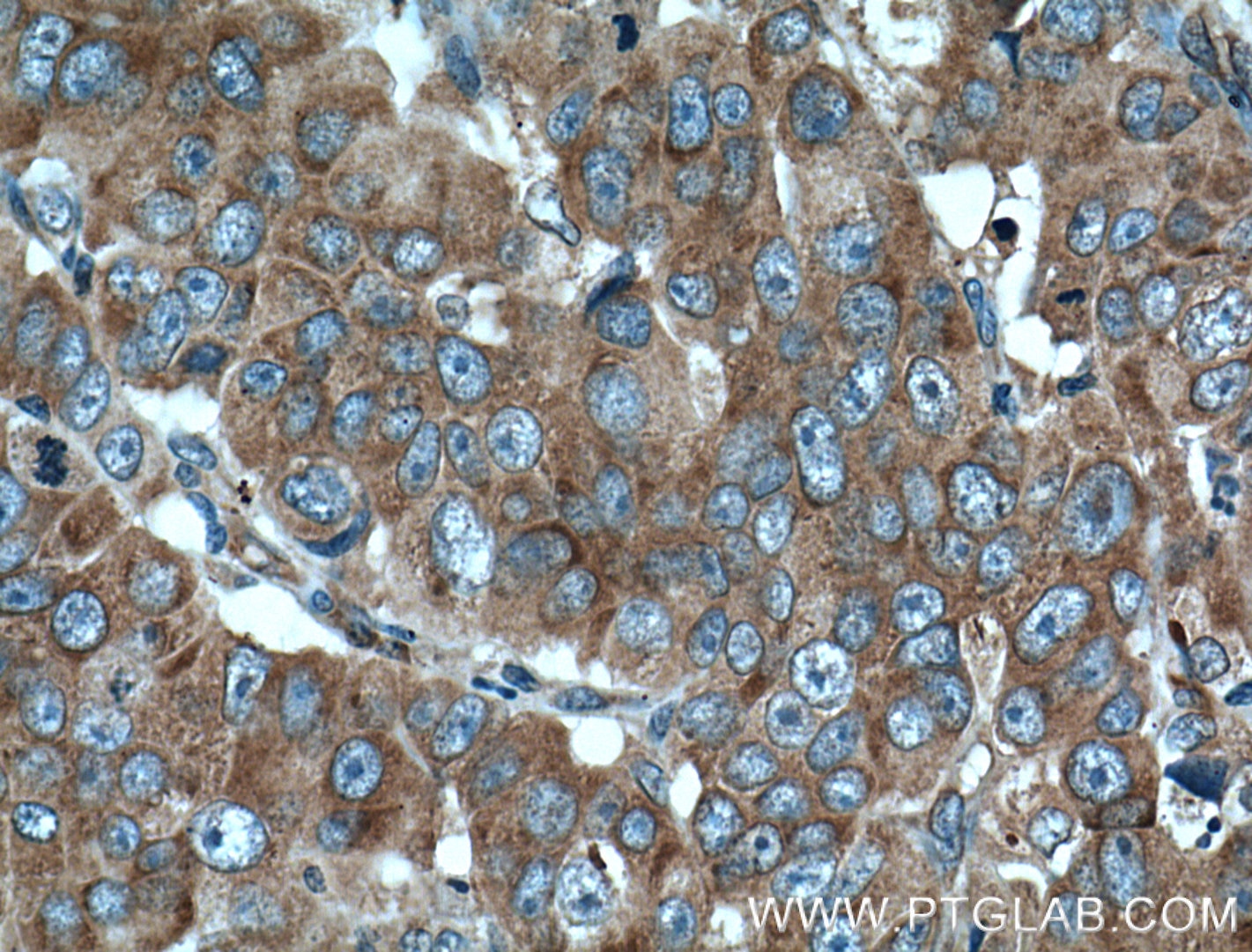 Immunohistochemistry (IHC) staining of human prostate cancer tissue using RPL3 Monoclonal antibody (66130-1-Ig)