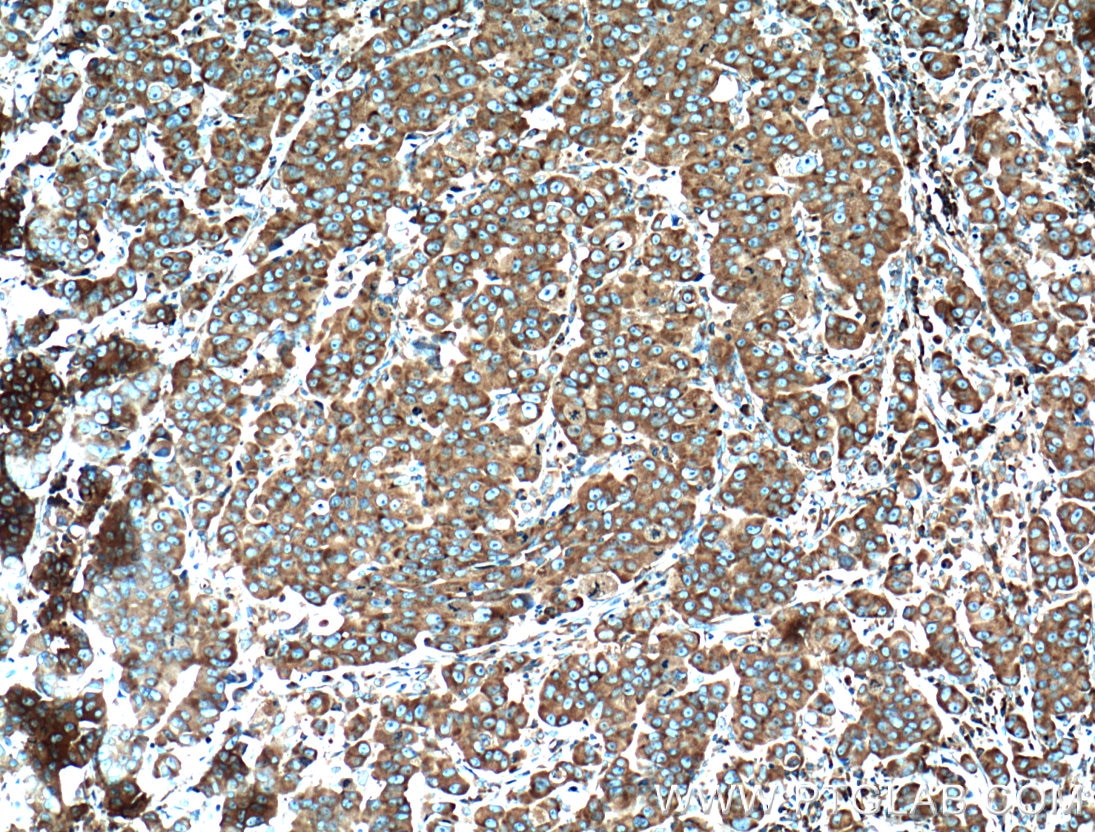 IHC staining of human prostate cancer using 66130-1-Ig