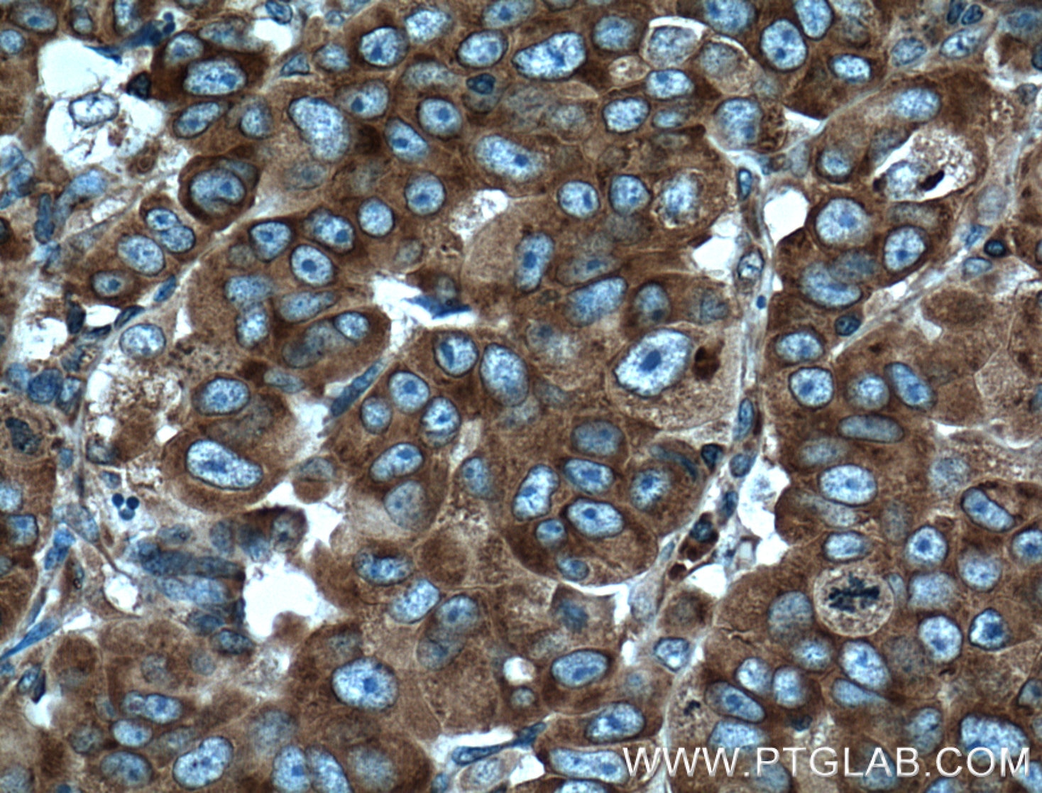 IHC staining of human prostate cancer using 66130-1-Ig