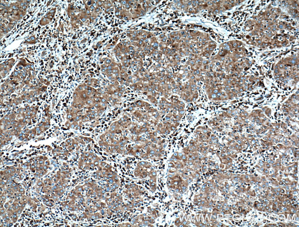 Immunohistochemistry (IHC) staining of human liver cancer tissue using RPL3 Monoclonal antibody (66130-1-Ig)