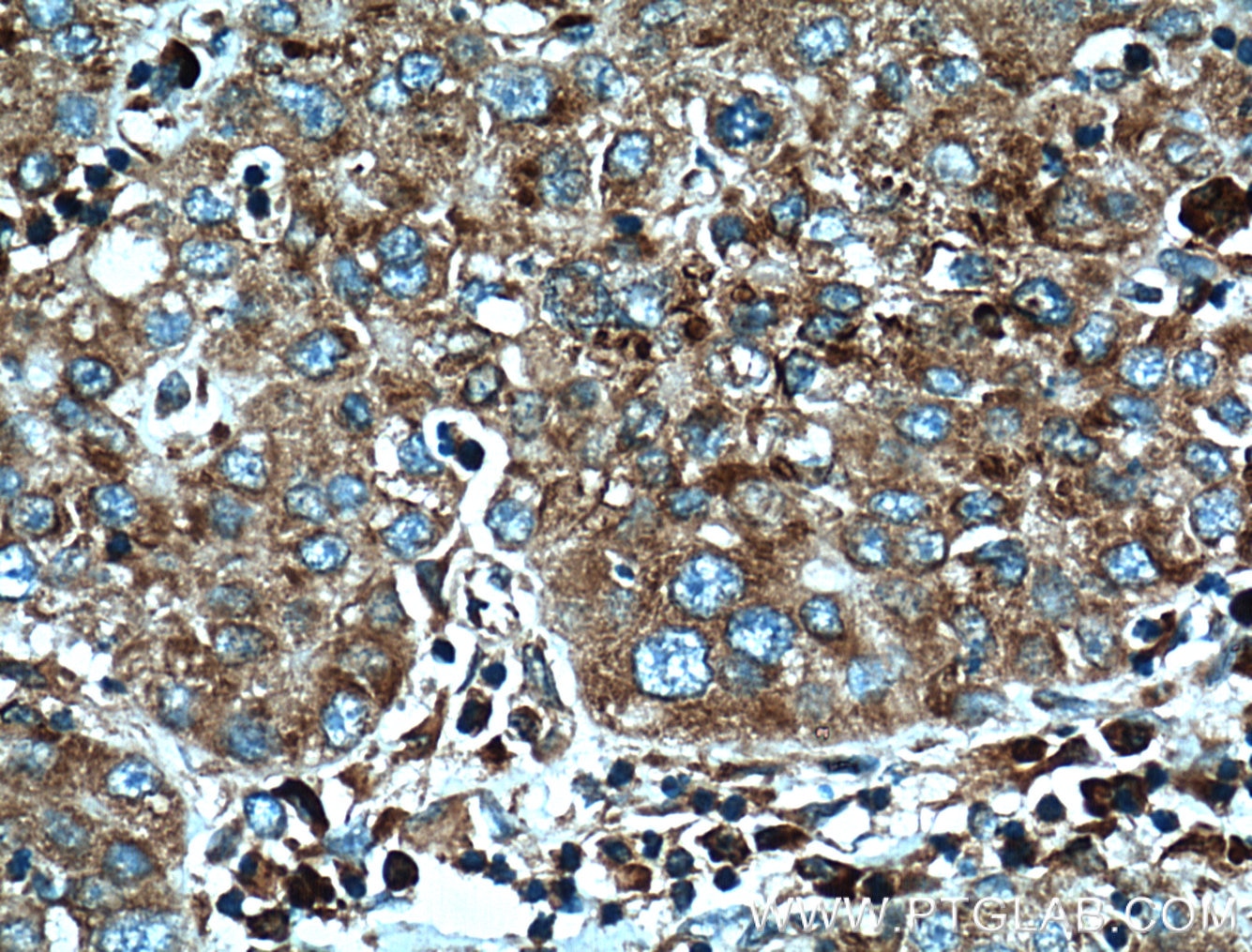 IHC staining of human liver cancer using 66130-1-Ig